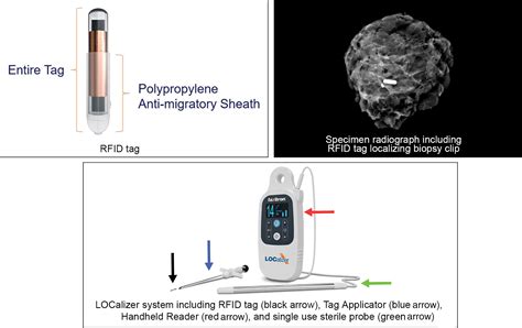 what do the rf tags do placed in cardia area|rfid tagging breast cancer.